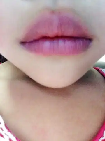 女儿嘴唇太厚怎么办
